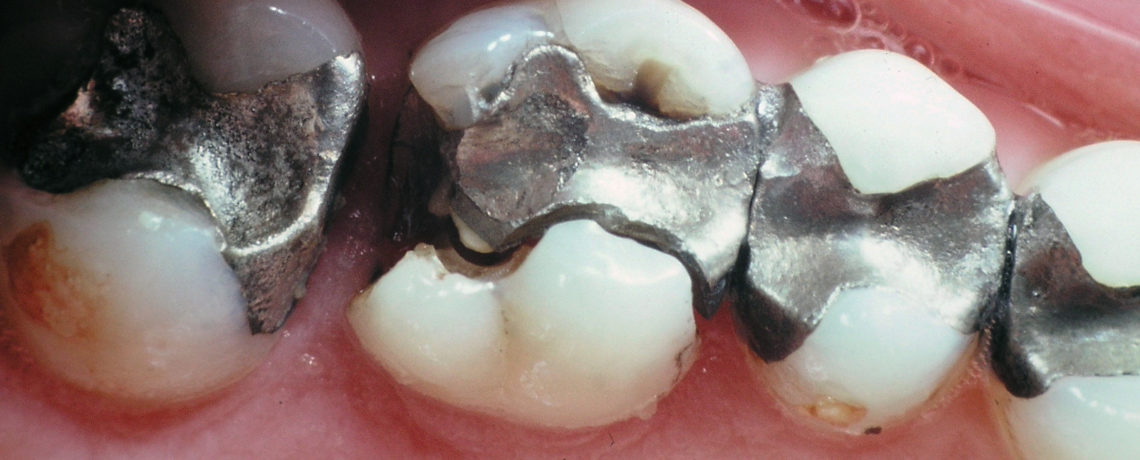 Dental Amalgams and Chronic Disease